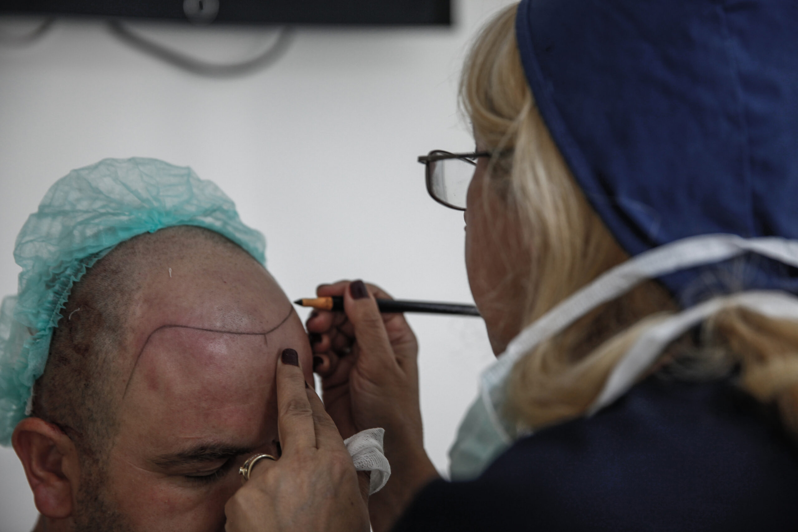 What are the Causes of Hair Loss