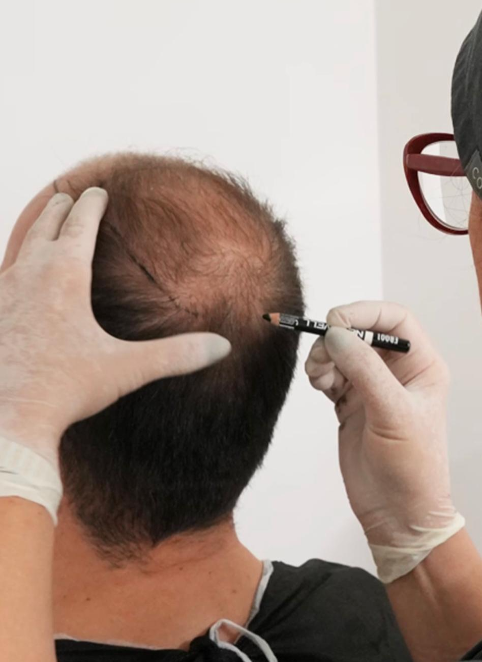 Saç Ekimi Sonrası İlk Haftada Neler Beklenmeli?