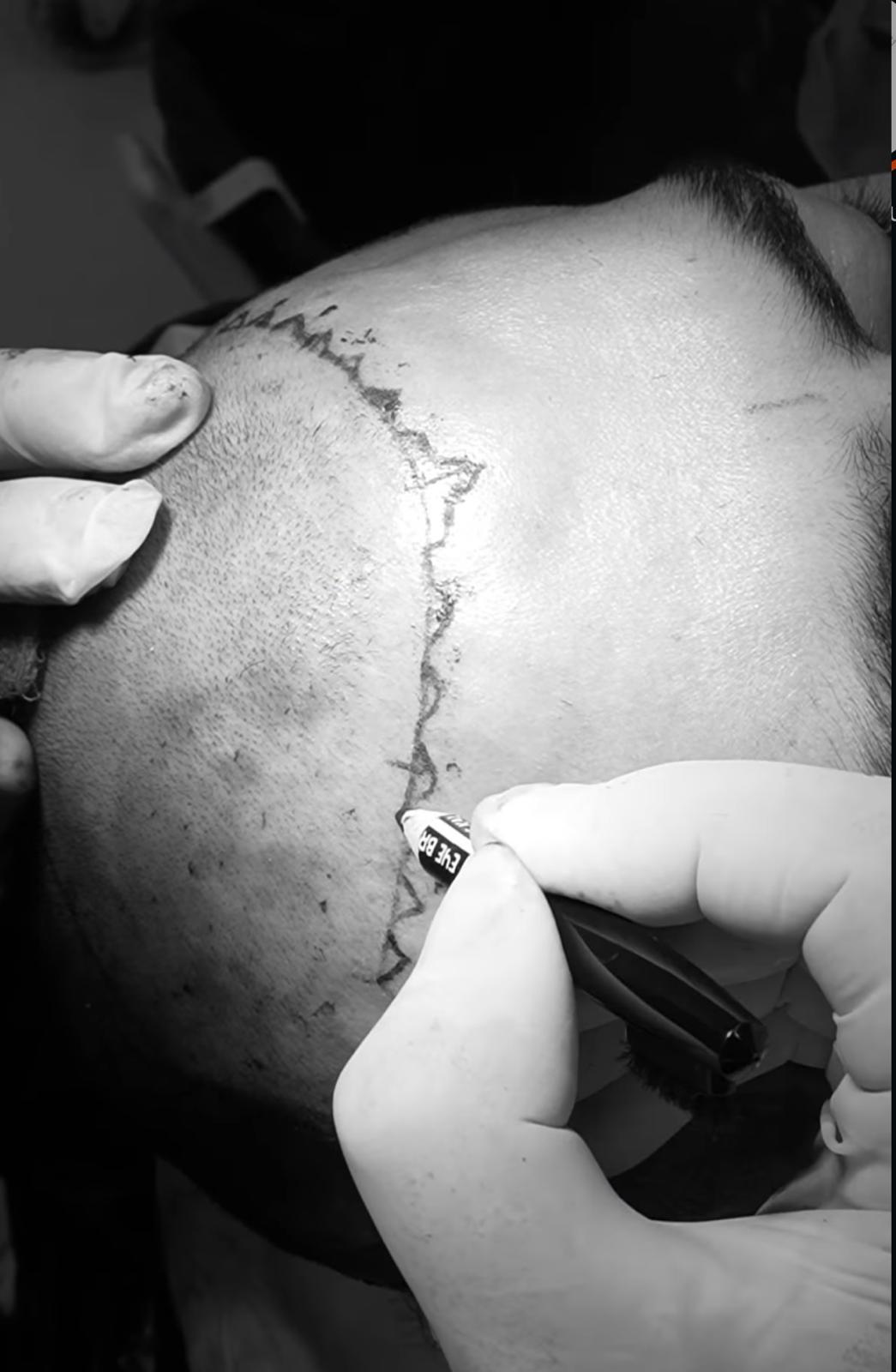 Saç Restorasyonunda “Hair Mill” Ne Anlama Gelir?