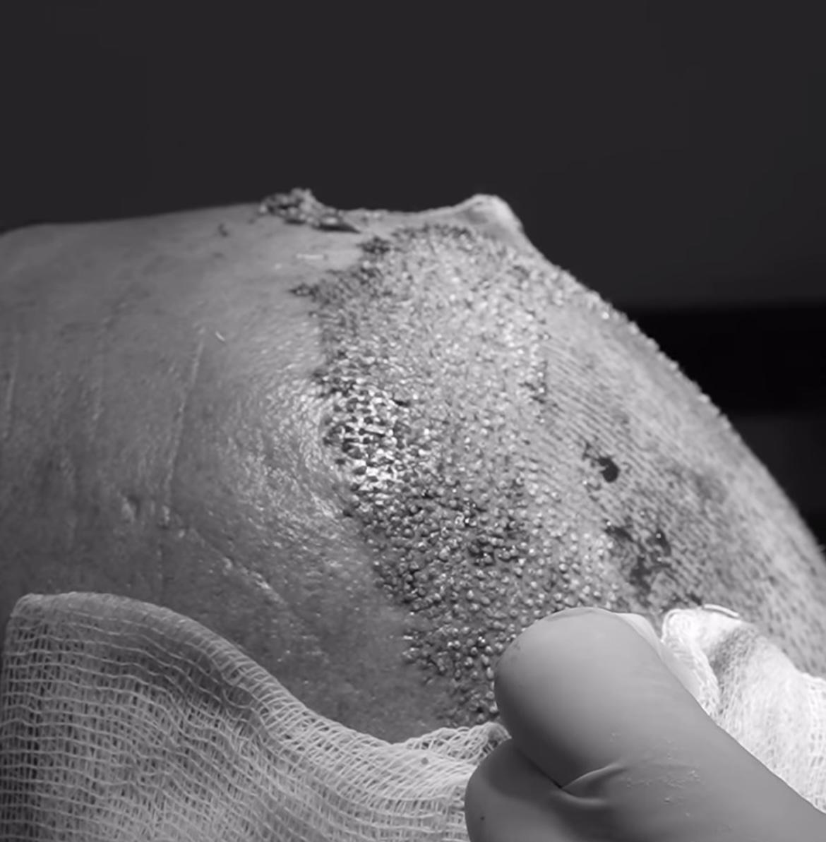 What are the Causes of Hair Thinning in Women