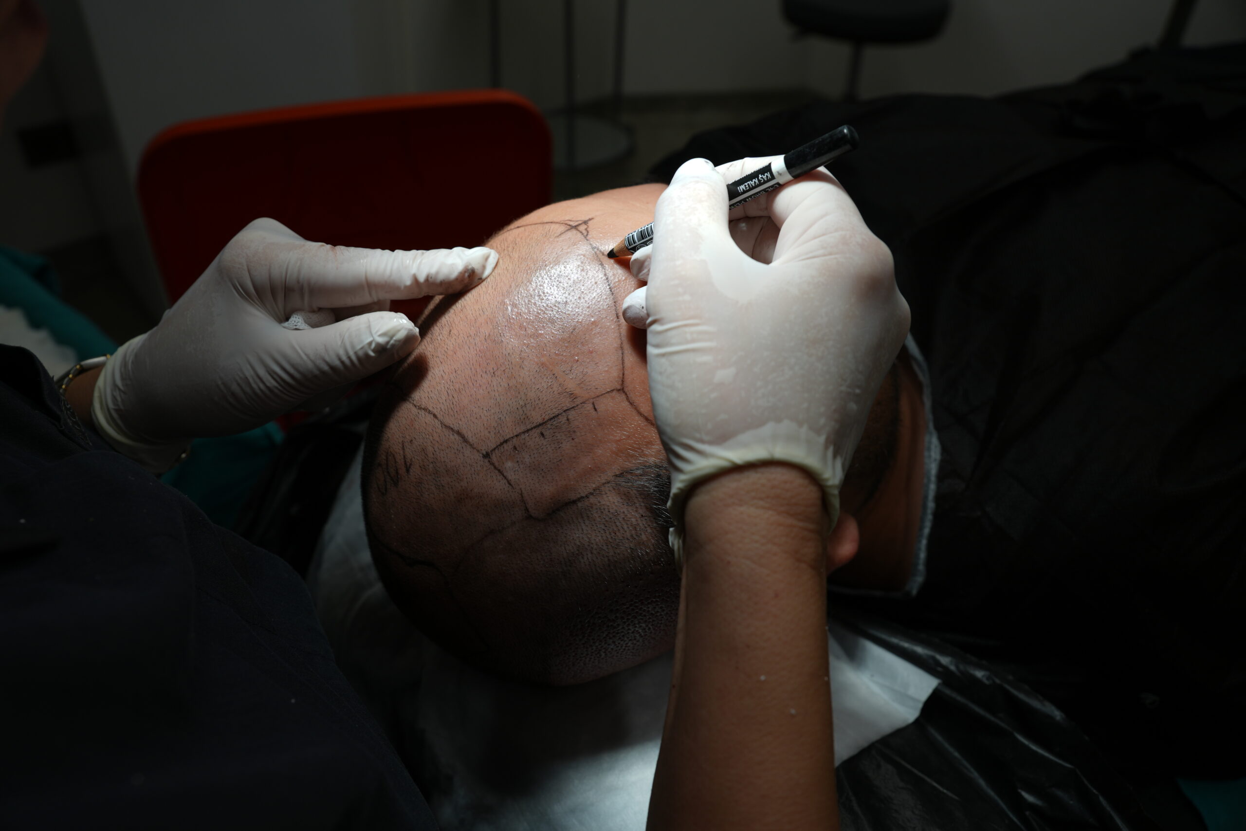 What Is Post-Finasteride Syndrome and Is Finasteride Safe for Hair Loss Treatment?