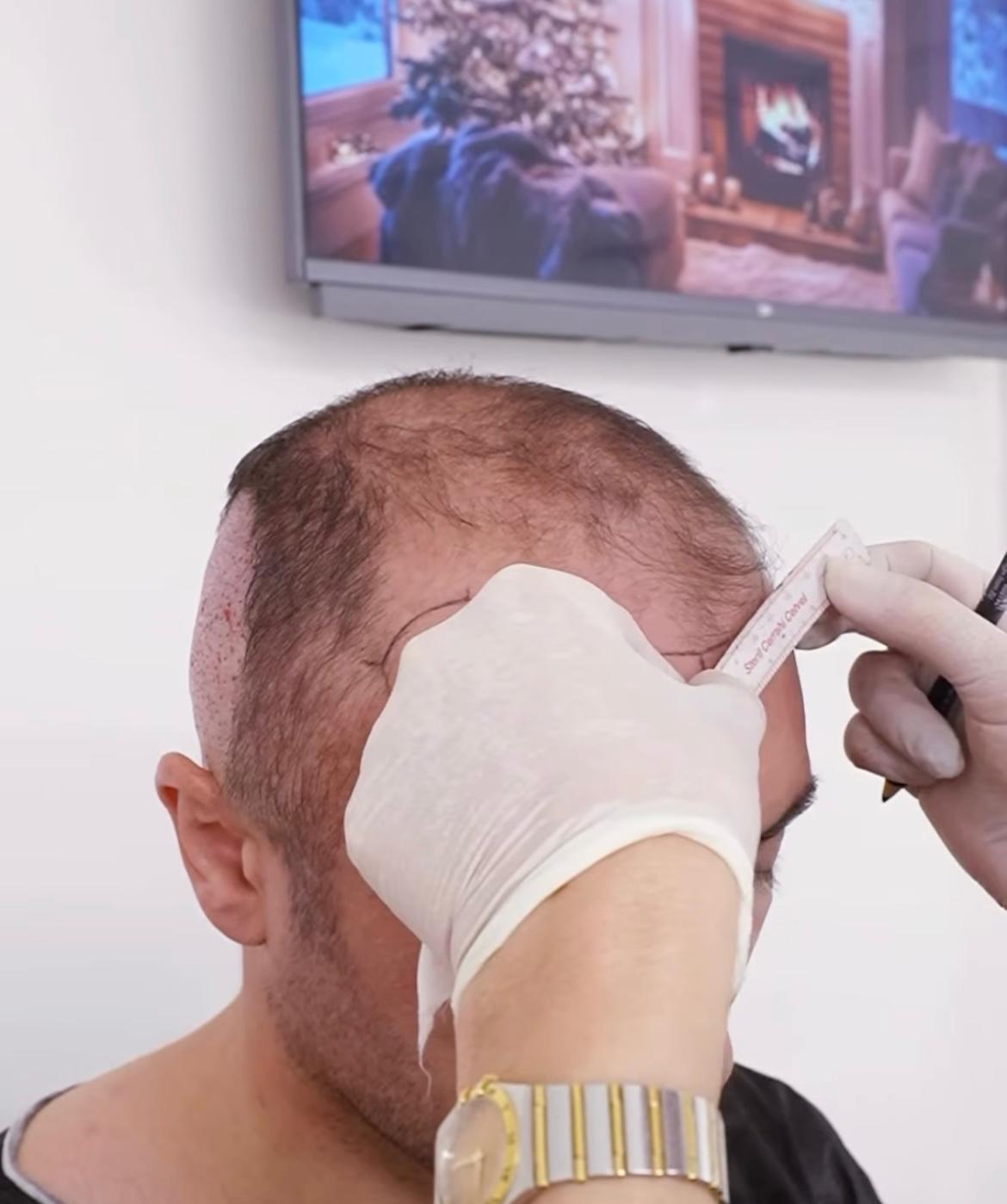 How Aging Affects Hair Loss?