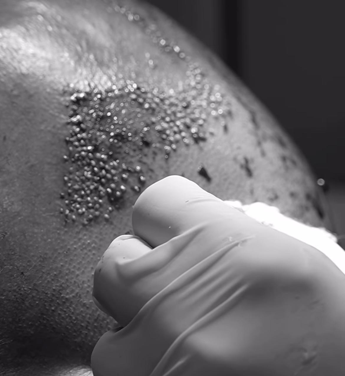 How Does Sapphire FUE Differ from Conventional FUE?