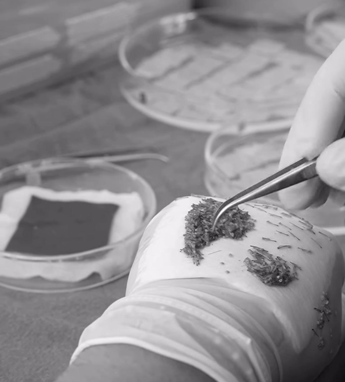 What Are the Benefits of Sapphire FUE Hair Transplant?